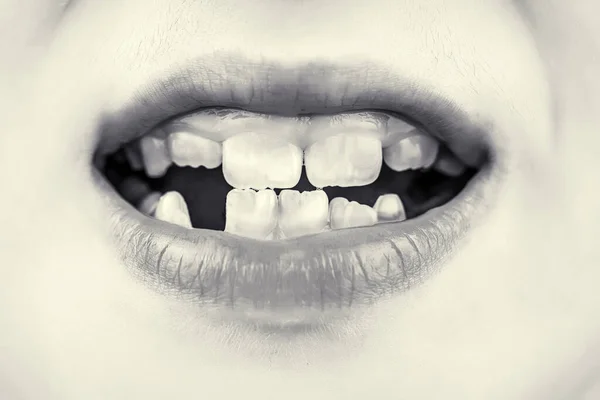 Zblízka Nezdravé Dětské Zuby Dětská Pacientka Otevřenými Ústy Vykazující Zubní — Stock fotografie