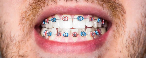 Close to the teeth braces on the white teeth of man to equalize the teeth. Dental concept.