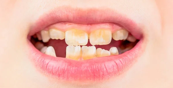 Κοντινό Πλάνο Ανθυγιεινών Δοντιών Μωρών Παιδικός Ασθενής Ανοιχτό Στόμα Που — Φωτογραφία Αρχείου