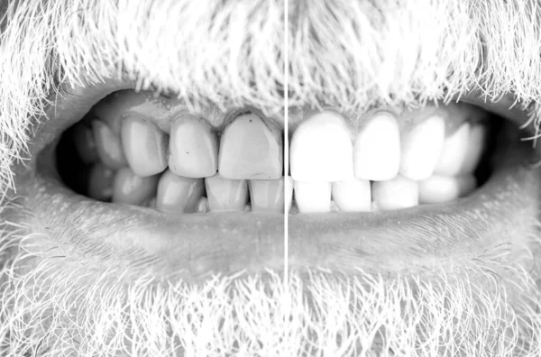 Close-up Of A Smiling man Teeth Before And After Whitening. Male teeth before and after whitening, oral care dentistry, stomatology. Black and white.