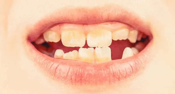 아이들은 미소를 이빨을 모습을 보여준다 건강에 아기의 접근이 충치가 치아를 — 스톡 사진