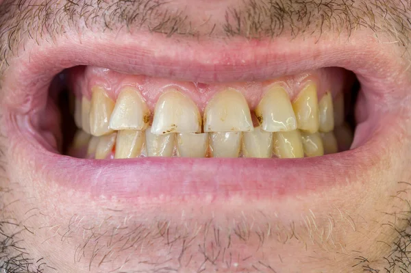 Ošklivé Zuby Muže Křivé Špinavé Plaketou Zblízka Zubní Lékařství — Stock fotografie
