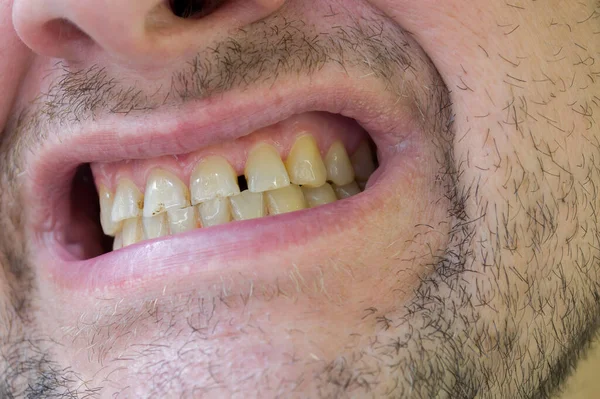 Nie Ciasno Pasujące Żółte Zęby Człowieka Płytką Nazębną Próchnicą — Zdjęcie stockowe