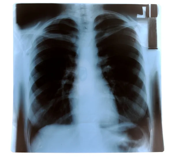 Røntgen af lunger - Stock-foto