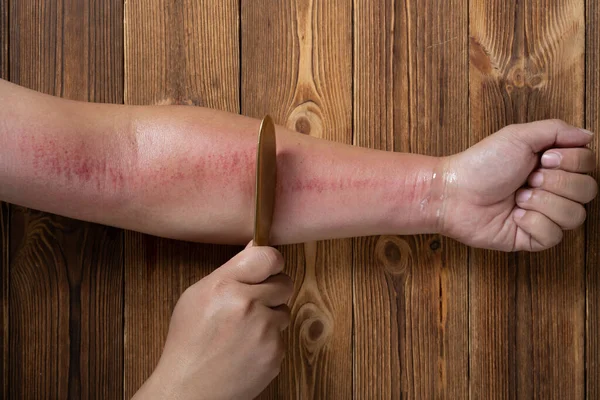 Mann Kratzt Sich Mit Einem Kupferkratzer Arm Das Ist Eine — Stockfoto