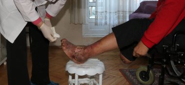 Treatment of gangrene foot . Debridement diabetic foot clipart