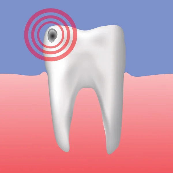 Díru v zubu — Stockový vektor