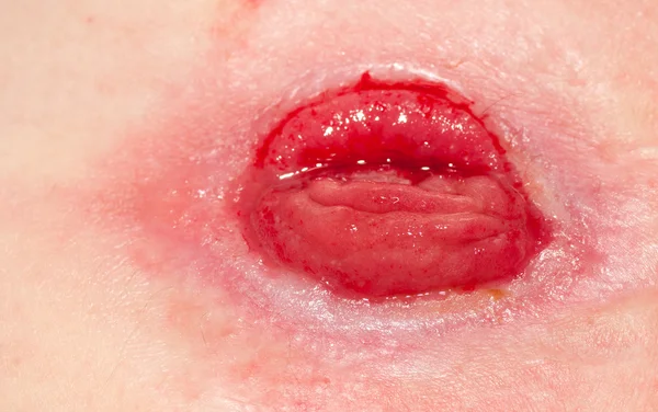 ileostomisine stoma