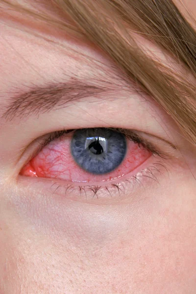 Besmette oog. Stockafbeelding