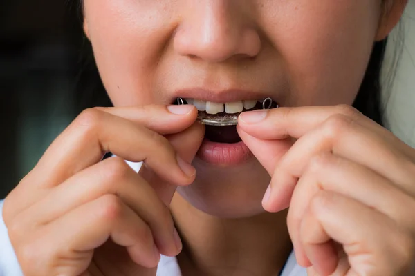 Teeth with retainer — Stock Photo, Image