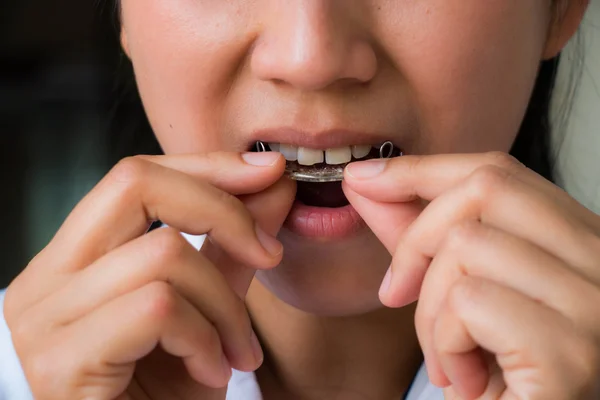 Dientes con retenedor — Foto de Stock