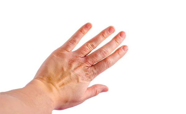 Irritación Piel Dermatitis Muñeca Izquierda Foto Alta Calidad — Foto de Stock