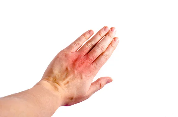 Irritación Piel Dermatitis Muñeca Izquierda Foto Alta Calidad — Foto de Stock