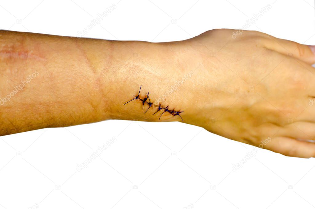 stitches after surgery isolated background. High quality photo