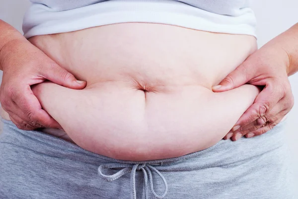 Gordura parte do corpo feminino . — Fotografia de Stock