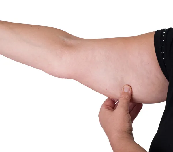 Arm fat — Stock Photo, Image