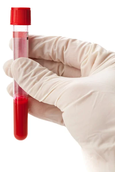 Verificação da amostra de sangue — Fotografia de Stock