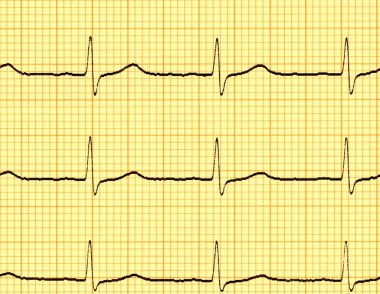 Elektrokardiyogram (EKG)