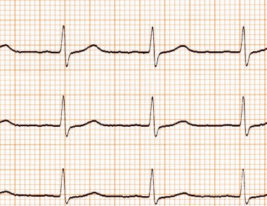Elektrokardiyogram (EKG)