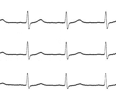 Elektrokardiyogram (EKG) satırları