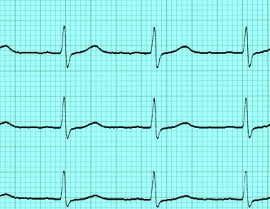 Elektrokardiyogram (EKG)