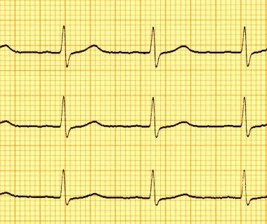 Elektrokardiyogram (EKG)