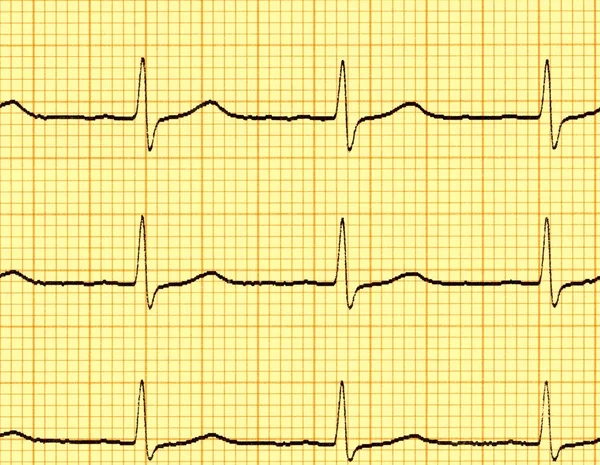 Elektrokardiyogram (EKG)