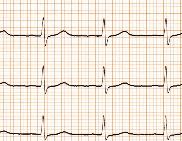 Électrocardiogramme (ecg ) — Photo