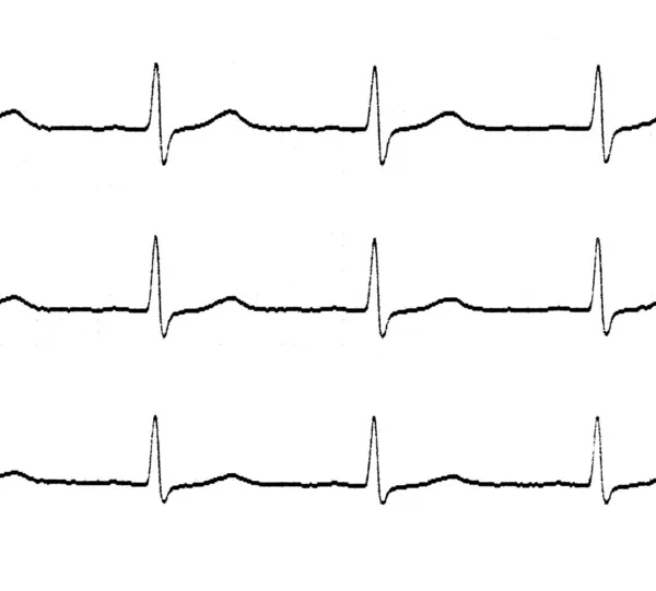 Líneas de electrocardiograma (ecg) —  Fotos de Stock