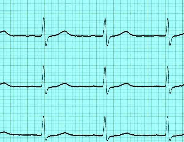 Électrocardiogramme (ecg ) — Photo