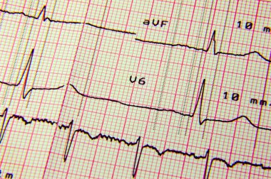 EKG ekg okuma sayfası