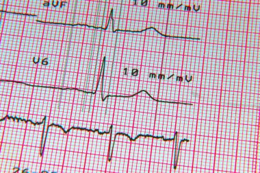 Elektrokardiyogram EKG