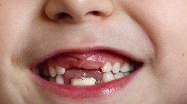 Yeni patlayan dişleri olan 6-7 yaşlarında bir kızın yakın çekimi. Süt dişi kaybı. yeni diş çıkarma