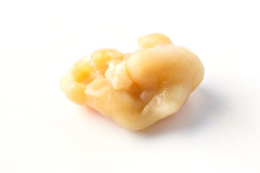 Tonsillolith