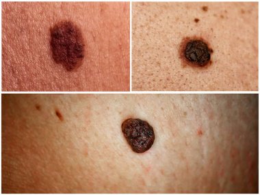 Photo Collage of different moles on human skin. clipart