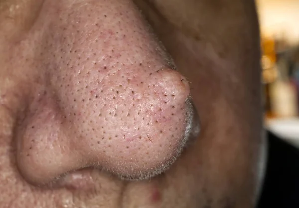 Female Nose Wart Papilloma Macro Photo Selective Focus — Stock Photo, Image