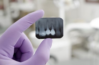Diş Xray 'i