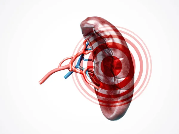 Ilustración 3D anatómicamente precisa del bazo de órganos internos humanos con enfermedad — Foto de Stock