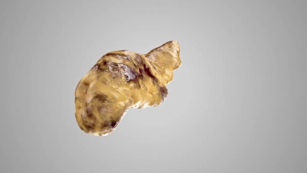 Натурная Анимация Анатомической Точности Поджелудочной Железы Человека Панкреатитом Острый Геморрагический — стоковое видео