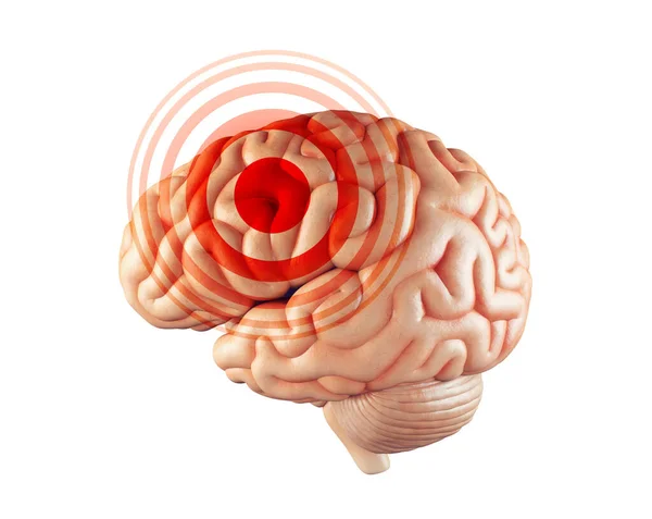 Ασθένεια Πόνος Έννοια Του Ανθρώπινου Εγκεφάλου Απομονώνονται Λευκό Κόκκινο Σημάδι — Φωτογραφία Αρχείου