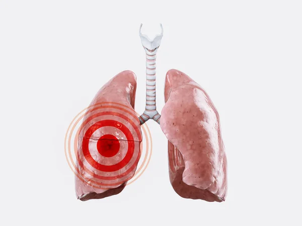 Choroba Lub Koncepcja Bólu Płuc Człowieka Izolowane Białym Czerwonym Znakiem — Zdjęcie stockowe