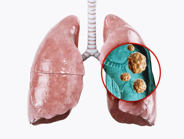 Pulmones Humanos Dañados Por Cáncer Ilustración Pulmón Con Tejido Canceroso —  Fotos de Stock