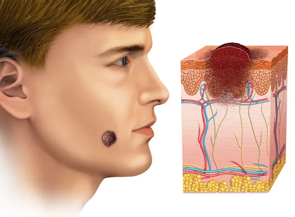 Melanoma no rosto Imagem De Stock