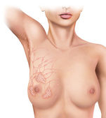 Karcinom prsu