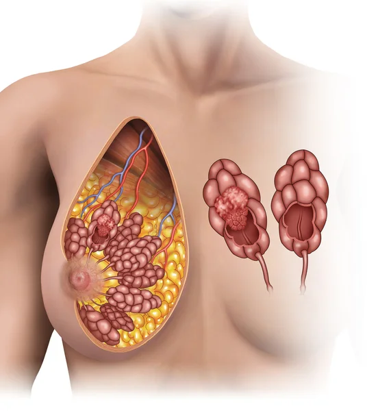 Emlő tumor Jogdíjmentes Stock Fotók