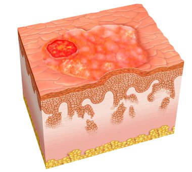 Squamous cell carcinoma clipart