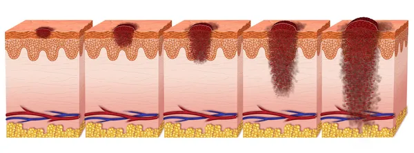 Melanoma — Foto Stock