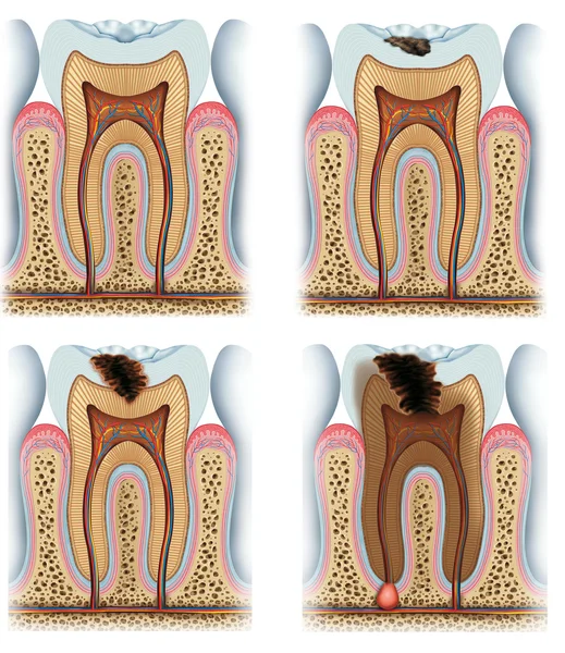 Fasi della carie dentale — Foto Stock