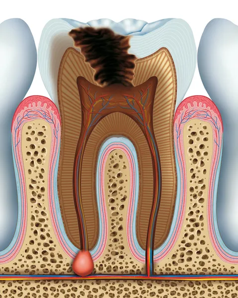 Caries dentaires — Photo