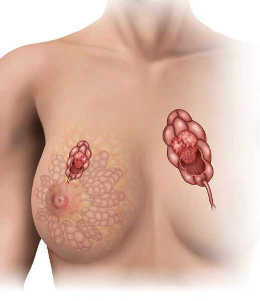 Mammary tumor lobe